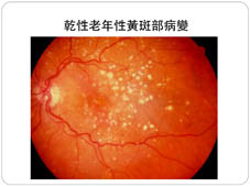 正中心怎麼看不清楚? 談老年性黃斑部病變(相關圖片)