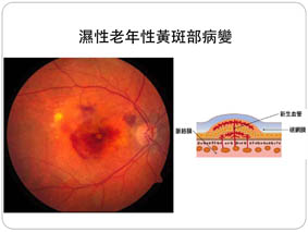 正中心怎麼看不清楚? 談老年性黃斑部病變(相關圖片)