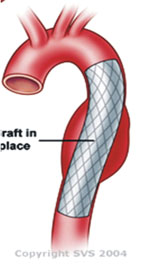 治療主動脈疾病救命器  主動脈覆膜支架(相關圖片)