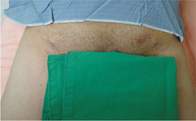 治療主動脈疾病救命器  主動脈覆膜支架(相關圖片)