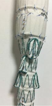 治療主動脈疾病救命器  主動脈覆膜支架(相關圖片)