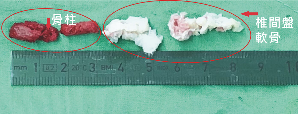 傷口小、恢復快  經皮內視鏡脊椎微創手術(相關圖片)