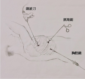 令人害怕的無聲癌症 『食道癌』(相關圖片)