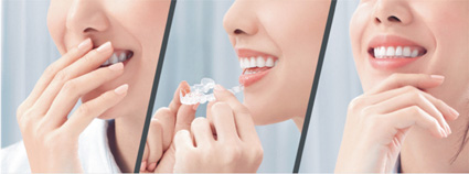 齒顎矯正治療  隱形牙套讓你悄悄變美麗(相關圖片)