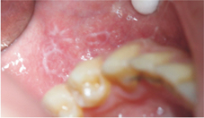  注意口腔衛生、勿食用刺激的食物    談口腔扁平苔癬(相關圖片)