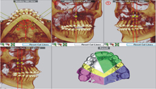 電腦輔助系統讓正顎手術、植牙和顏面部重建更快更準(相關圖片)