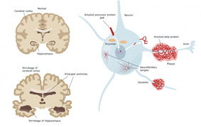 失智症的解藥在哪裡 ?(相關圖片)