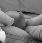 小鳥的二三事   談小兒包莖及包埋性陰莖(相關圖片)