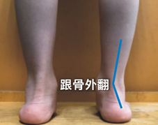 腳不對，整個身體都不對  談兒童下肢發展與扁平足(相關圖片)