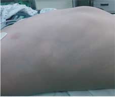 漏斗胸患者的福音 健保給付納式微創矯正手術醫材 (相關圖片)
