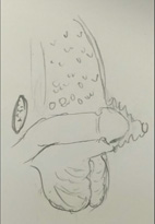 小鳥的二三事   談小兒包莖及包埋性陰莖(相關圖片)