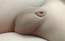 小鳥的二三事   談小兒包莖及包埋性陰莖(相關圖片)