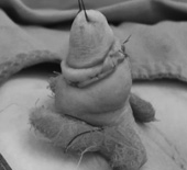 小鳥的二三事   談小兒包莖及包埋性陰莖(相關圖片)