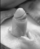 小鳥的二三事   談小兒包莖及包埋性陰莖(相關圖片)