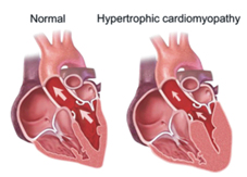 胸悶別輕忽！  談肥厚性心肌病變(相關圖片)