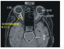 精準放療  重見光明     亞東醫療跨科攜手達成不可能的任務(相關圖片)