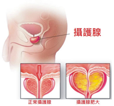 總是尿不準,瞄不準的蒼蠅 談攝護腺肥大(相關圖片)