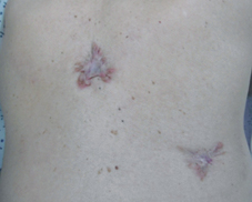 蟹足腫醜疤掰掰! 放射治療讓「疤痕」平整(相關圖片)