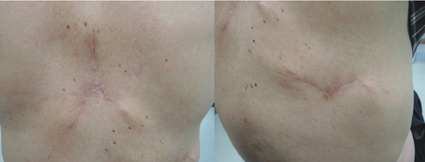 蟹足腫醜疤掰掰! 放射治療讓「疤痕」平整(相關圖片)