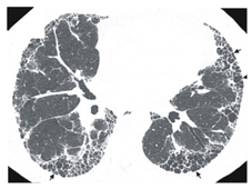 小心「菜瓜布肺」(相關圖片)