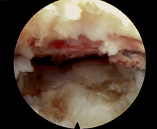 手麻、腳麻 可能是椎間盤突出症(相關圖片)