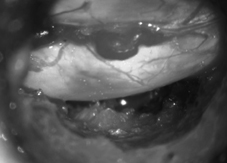 手麻、腳麻 可能是椎間盤突出症(相關圖片)