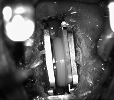 手麻、腳麻 可能是椎間盤突出症(相關圖片)