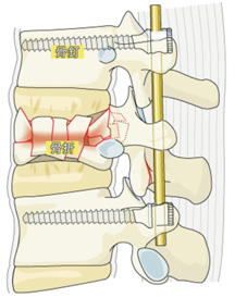 椎骨折處置   灌骨水泥椎體定形就搞定(相關圖片)