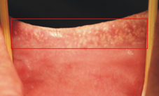 白白的東西是口腔癌嗎？ 常見的口腔黏膜狀況(相關圖片)