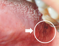 白白的東西是口腔癌嗎？ 常見的口腔黏膜狀況(相關圖片)