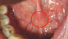 白白的東西是口腔癌嗎？ 常見的口腔黏膜狀況(相關圖片)