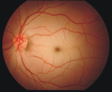 傷口的救星 『高壓氧』治療 (相關圖片)