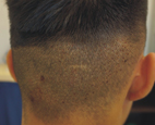 搶救『頭頂上危機』應把握黃金治療期   『微創植髮』(相關圖片)