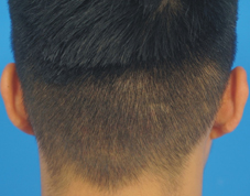 搶救『頭頂上危機』應把握黃金治療期   『微創植髮』(相關圖片)