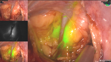 前哨淋巴結造影 讓癌症見光死(相關圖片)