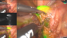 前哨淋巴結造影 讓癌症見光死(相關圖片)