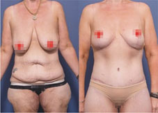 大量減重與身形重塑(相關圖片)