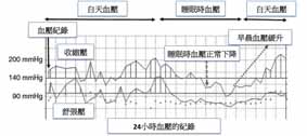 高血壓也可不『藥』而癒？   阻塞性睡眠呼吸中止症與高血壓(相關圖片)