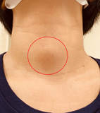 別疏忽! 你不可不知的甲狀腺結節(相關圖片)