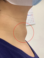 別疏忽！ 你不可不知的甲狀腺結節(相關圖片)