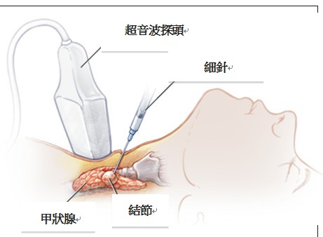 別疏忽! 你不可不知的甲狀腺結節(相關圖片)