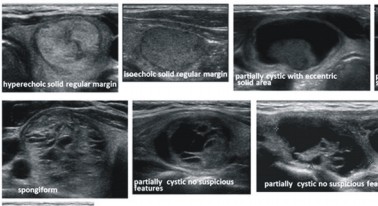 別疏忽! 你不可不知的甲狀腺結節(相關圖片)