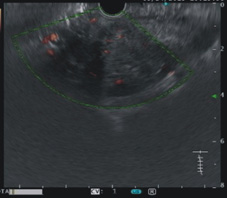 診斷『胰臟腫瘤』的新利器   對比增強諧波內視鏡超音波(相關圖片)