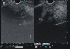 診斷『胰臟腫瘤』的新利器   對比增強諧波內視鏡超音波(相關圖片)