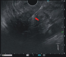 診斷『胰臟腫瘤』的新利器   對比增強諧波內視鏡超音波(相關圖片)