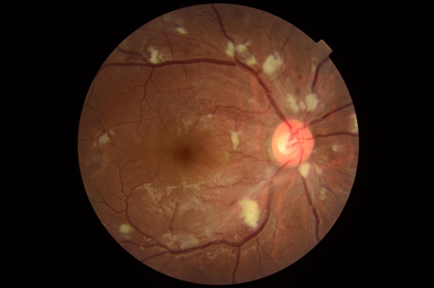 AI人工醫療技術  協助『糖尿病視網膜病變篩檢』   (相關圖片)