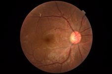 AI人工醫療技術  協助『糖尿病視網膜病變篩檢』   (相關圖片)