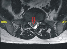 小突出大影響  椎間盤突出知多少(相關圖片)