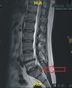 小突出大影響  椎間盤突出知多少(相關圖片)