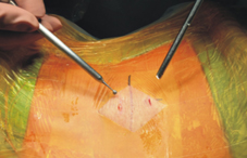 小突出大影響  椎間盤突出知多少(相關圖片)